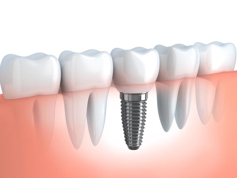 Dental Implants Denver, CO 